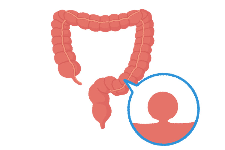 大腸ポリープイメージ画像