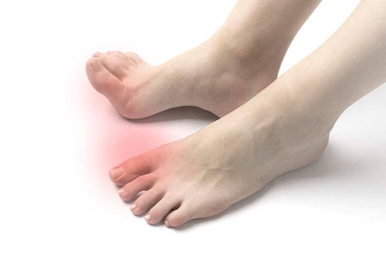 高尿酸血症イメージ画像